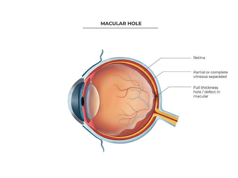 macular hole cape town