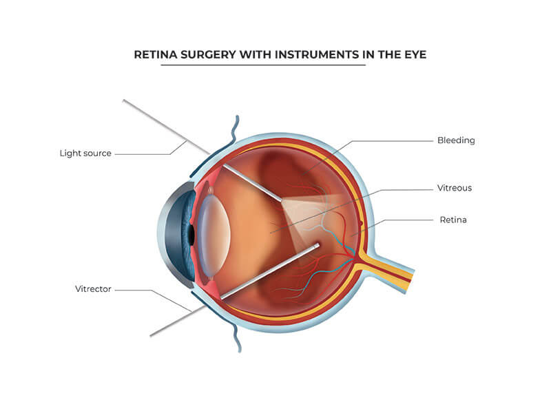 retinal detachment surgery south africa