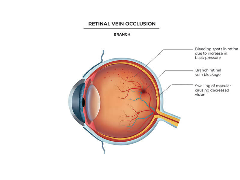 retinal vein occlusion cape town